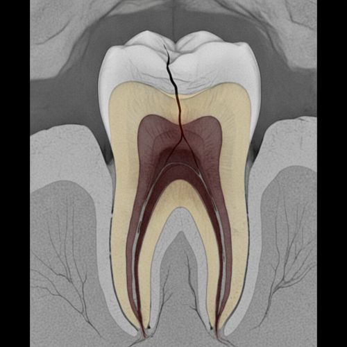 Muela partida por dentro: cómo detectarla, qué hacer y cuándo conviene ir al dentista